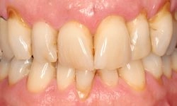 Before: misaligned teeth with visible decay