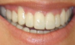 After: perfectly aligned teeth
