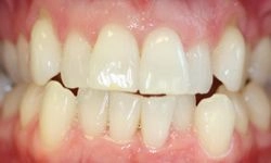 Before: misshapen and crooked teeth