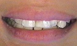 After: straightened smile