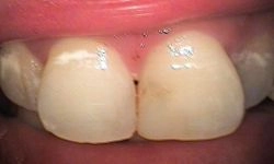 Before: front teeth extending beyond other teeth