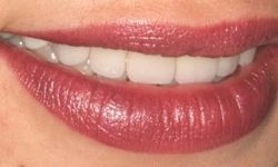 Smiling woman with straight, white teeth
