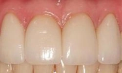 After: white teeth with no gaps